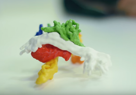 Impression 3D & Médical - modélisation tumeur